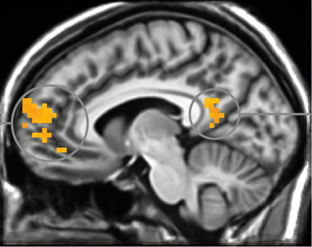 brain-mri-640x508.png