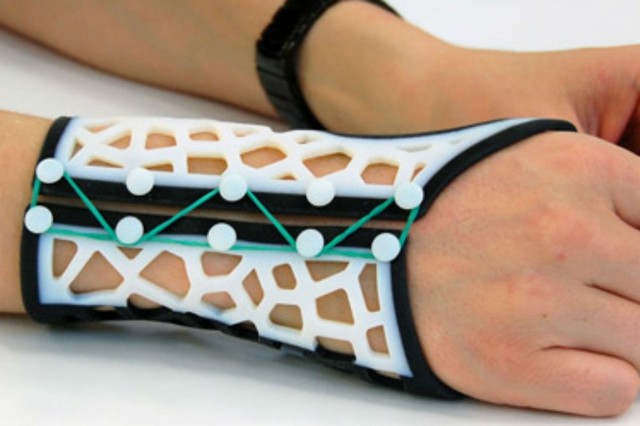 3D-printed splints may make life better for arthritis sufferers
