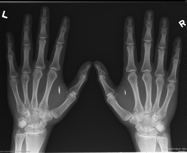 Tiny little chip implants, via X-ray.