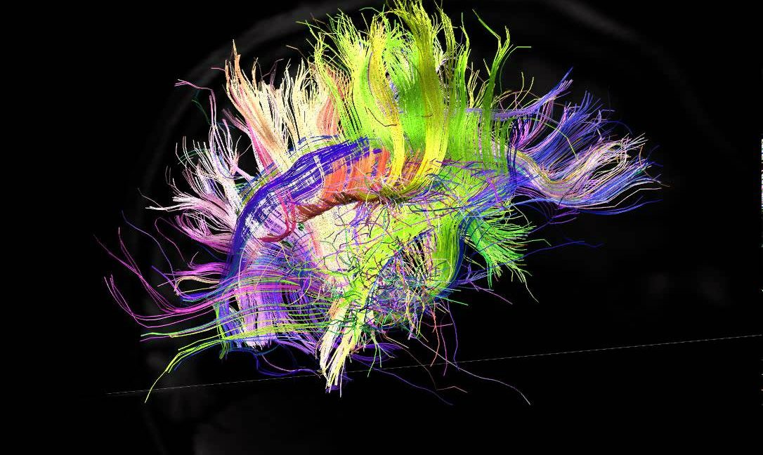 The connections in autistic brains are idiosyncratic and individualized