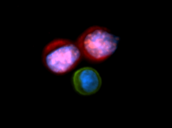 Two circulating tumor cells next to a white blood cell.