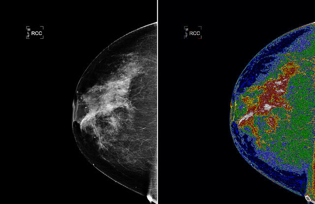 Mammograms every other year for women 50-74, gov’t panel recommends