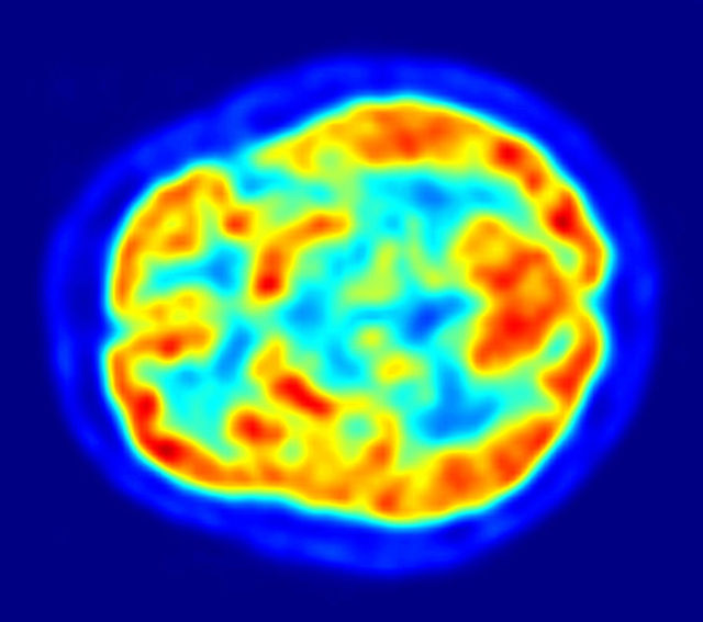 A PET scan uses glucose with a radioactive tag to tell us which regions of the brain are most active.