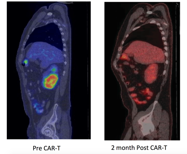 Shrinking of lymphoma after CAR T-cell therapy. Positron emission tomography (PET) images showing large tumor mass in the kidney (red arrow) prior to CAR-T cell therapy that completely regressed on a repeat PET scan performed 2 months after CAR-T cells.