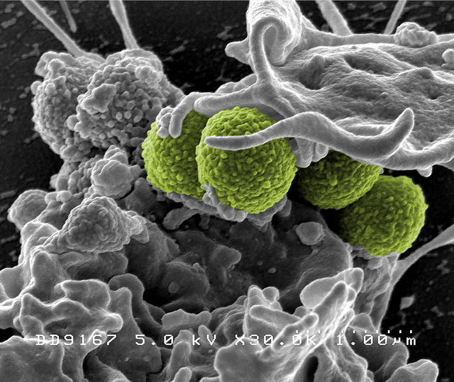 Hospital-associated Methicillin-resistant Staphylococcus aureus (MRSA) bacteria.