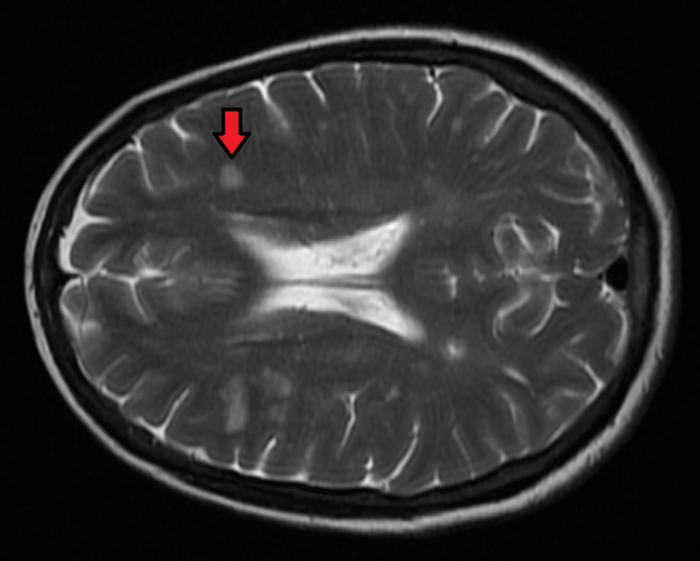 Brain Lesions Type Symptom Prevention And Treatment H - vrogue.co