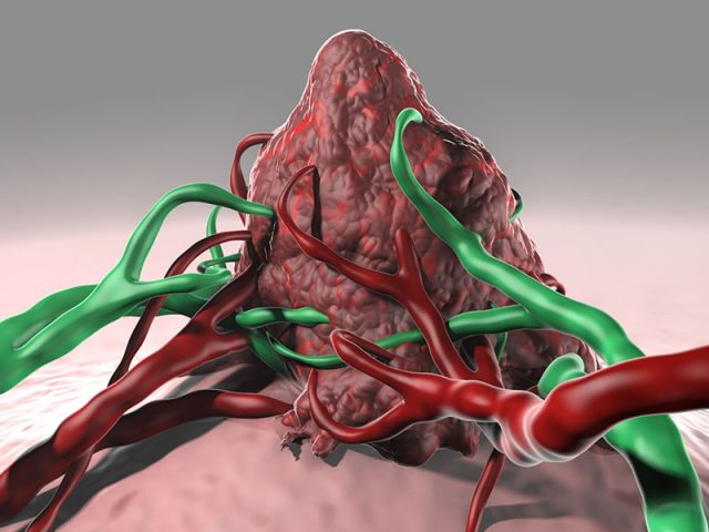 An artist's rendering of a brain tumor that can be killed off with the help of a virus.