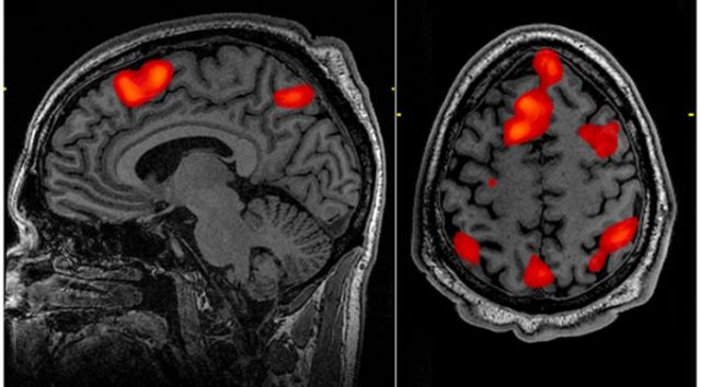fMRI images of a brain during a memory task (not from the present study). 
