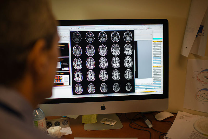 Researchers cautiously optimistic about new brain-clearing Alzheimer’s drug