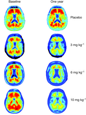 Brain imaging comparison of amyloid plaques (red) in those given placebo and those given aducanumab over the course of a year.