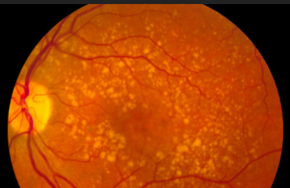 White Spots On Retinal Imaging