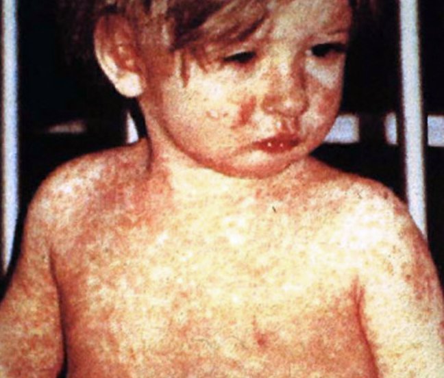 Child with a classic four-day rash from measles.