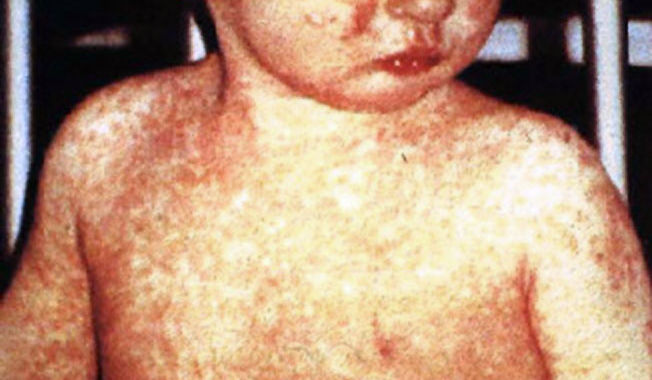 تفشي مرض الحصبة في ولاية أوهايو يصيب الأطفال الذين تم تطعيمهم جزئيًا ، والأطفال الصغار جدًا بحيث لا يتم تطعيمهم