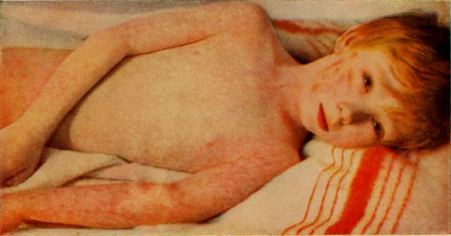 An example of a frightening image, in this case a child with measles, may convince some that vaccines have frightening side effects. 