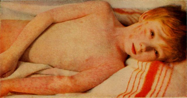 An example of a frightening image, in this case a child with measles, may convince some that vaccines have frightening side effects.