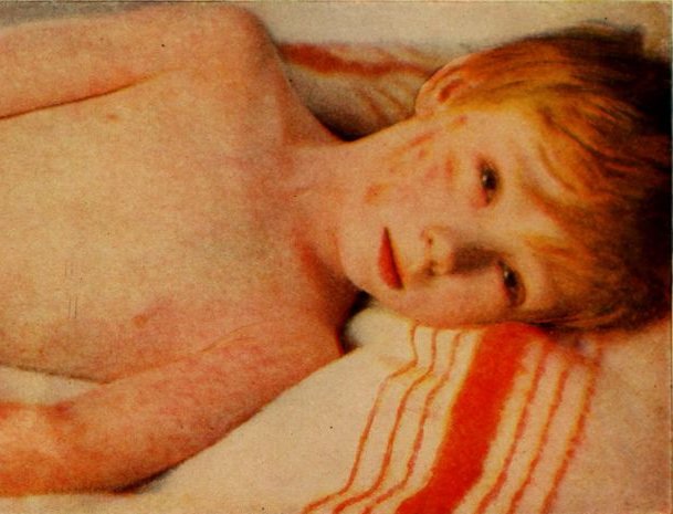 A child with measles.