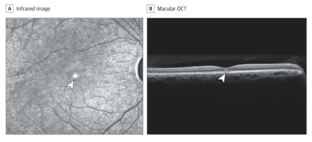 infrared (A) and macular optical coherence tomography (OCT) (B) images demonstrating a hyperreflective spot in the fovea (arrowheads), presumably a disruption of the inner and outer photoreceptor segments with no evidence of underlying retinal pigment epithelial defects, consistent with bilateral solar retinopathy .