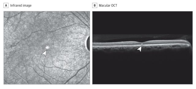 dark spot on retina scan