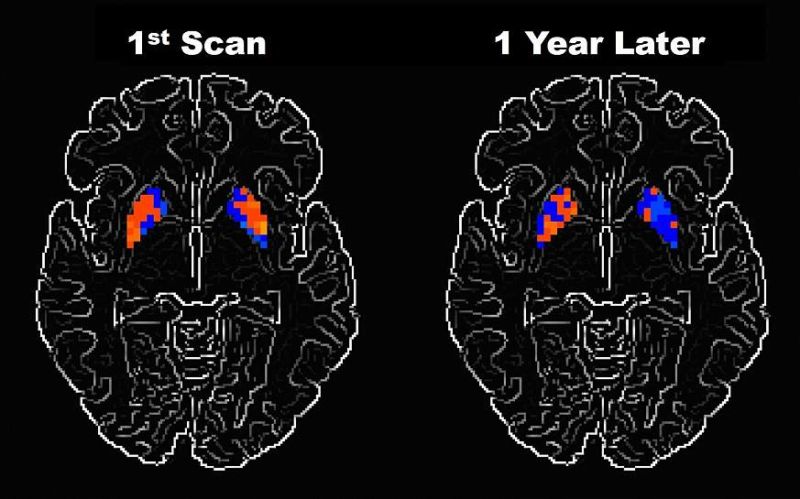 Activity drops in a specific area of the brain in Parkinson's patients.