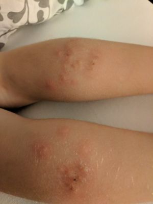 Szilagyi posted pictures of bites on her daughter's calves on Twitter.