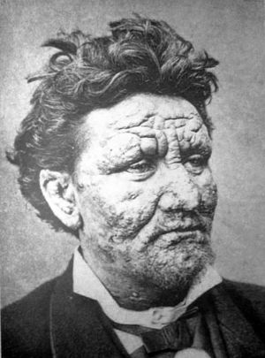 Arran Reeve, suffering from leprosy, circa 1886.