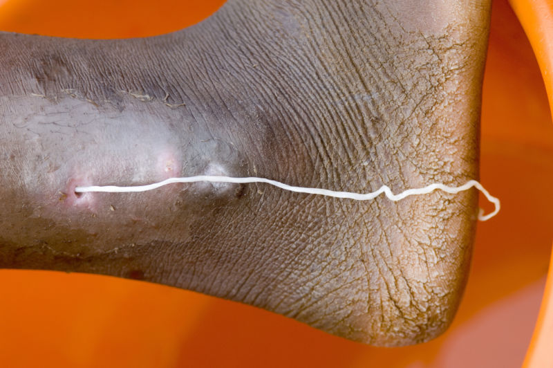 A patient with a guinea pig worm emerging, at the Savelugu Case Containment Center. 