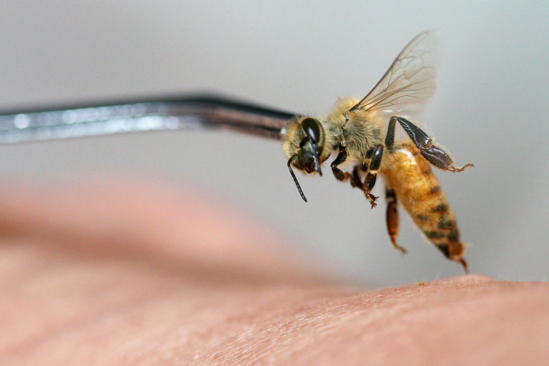 JAKARTA, Indonesia:  An apitherapy practitioner administers a bee sting to the hand of a patient. 