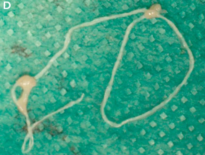 A close-up of a thin, long, yellowish D. repens pulled from the woman's face