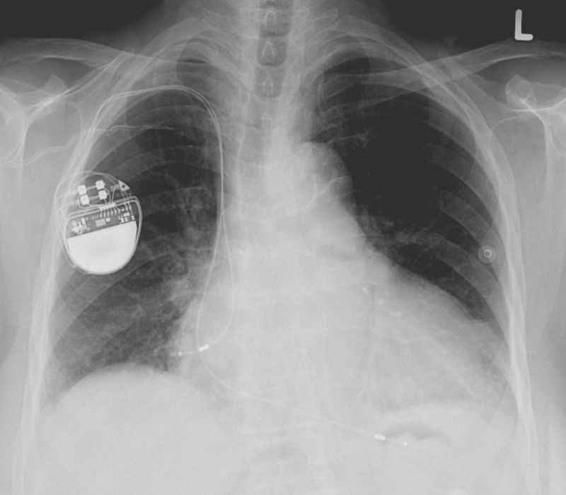 X-ray of a human chest with a pacemaker inside it.
