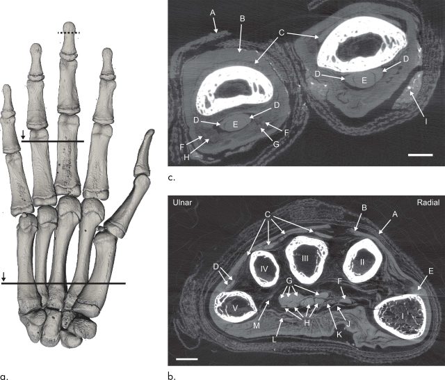 The left image shows the hand viewed palm-up, with lines indicating where the cross-sections are. On the right, the images show the hand, viewed from the fingertips. The lower image (b) shows all five digits, with arrows pointing to linen (A), skin (B), tendons (C) through (H), part of the carpal ligament (J), nerves (K) and (L), a possible artery (M). The upper image (c) shows a cross-section of the lower section of the third and fourth fingers, with arrows pointing to linen (A), skin (B), tendons (C) through (E), arteries (F), nerves (G) and (H), and embalming residue (I).