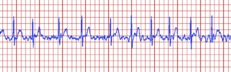 Image of a cardiac trace showing irregular activity.