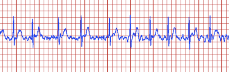 Image of a heart track showing irregular activity.