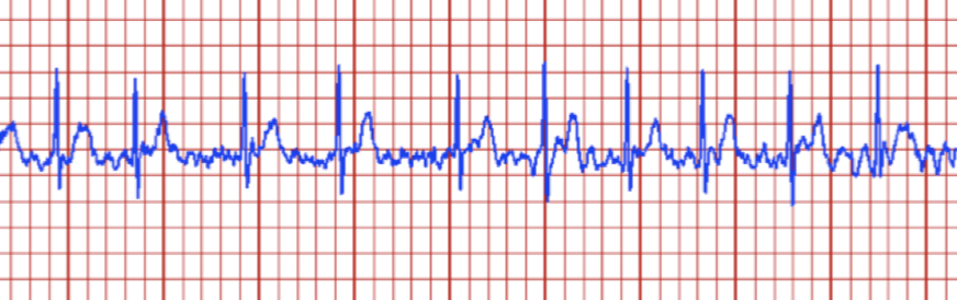 atrial fibrillation