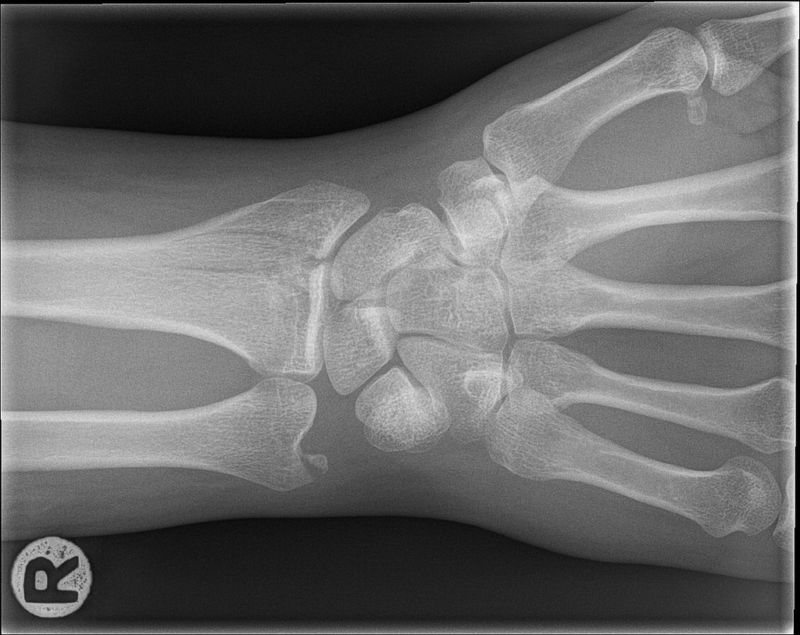   Image of an x-ray of the wrist. 