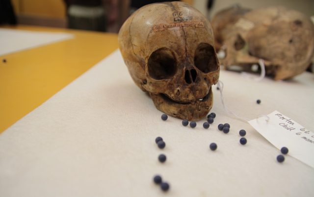 One of the skulls from Dr. Morton's collection, showing the lead shot he used to measure cranial capacity.