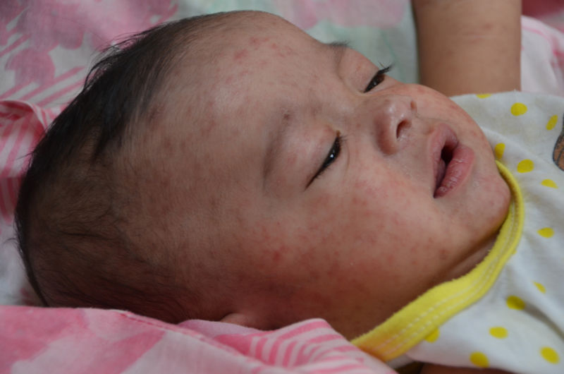 A baby with measles hospitalized in the Philippines after an outbreak after Typhoon Haiyan in 2013.