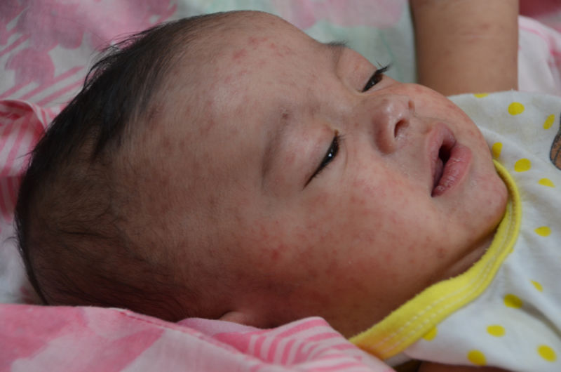 A baby hospitalized with measles in the Philippines, in an outbreak following 2013's typhoon Haiyan.