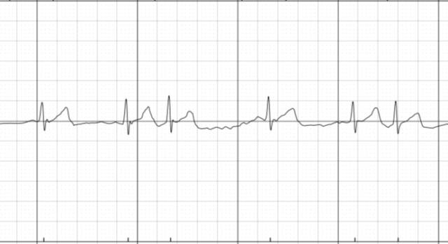 ecg reading apple watch