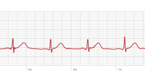 ecg heart rate apple watch