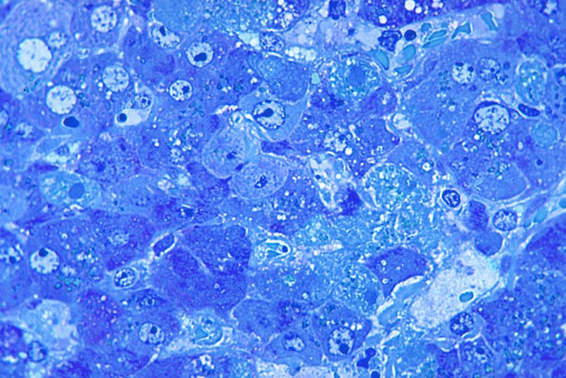 A micrograph of hepatitis caused by the Lassa virus