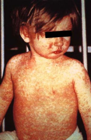 This child, who had had measles, showed the characteristic rash on the fourth day of his evolution.  Measles can cause hearing loss and brain damage, and it can be fatal in young children.