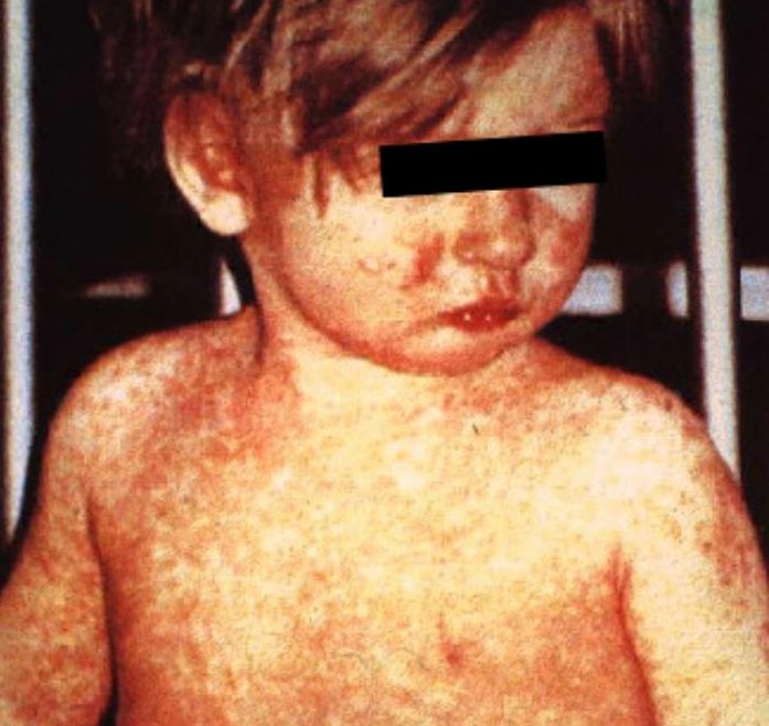 This child, who had measles, developed a characteristic rash on the fourth day of development.  Measles can cause hearing loss, brain damage and be fatal in young children.