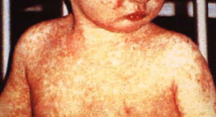 Measles outbreak erupts among unvaccinated children in Ohio daycare