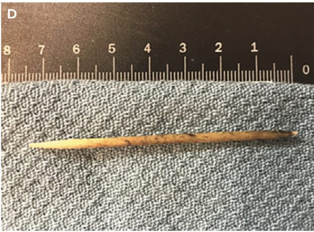 This gory medical case shows why you should never, ever swallow a ...