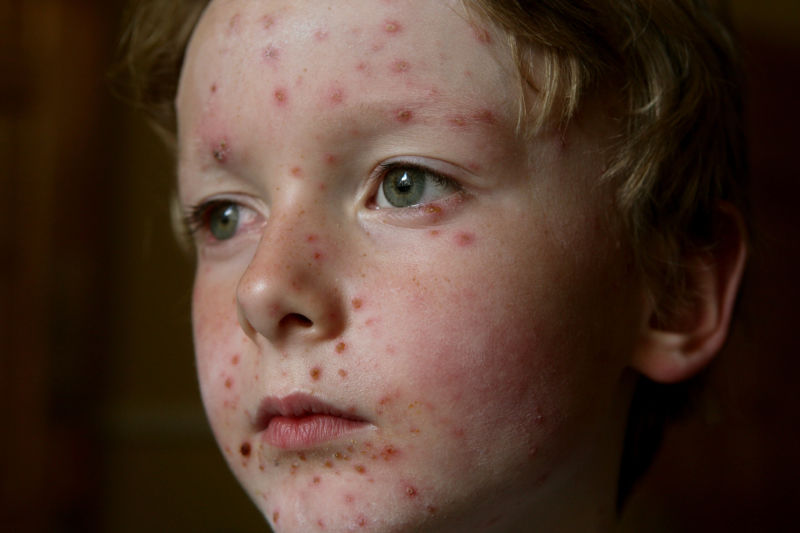  A child with chicken pox.   