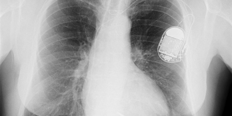 Critical Flaw Lets Hackers Control Lifesaving Devices Implanted Inside Patients Ars Technica