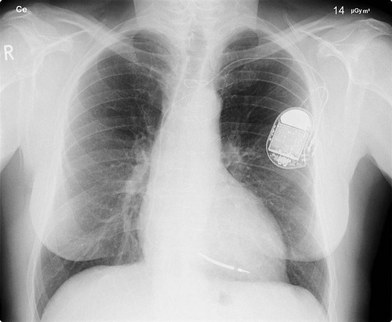 An X-ray showing an cardio defibrillator implanted in a patient.