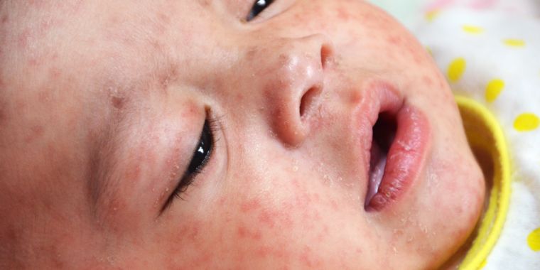 Measles is a 'growing global threat,' CDC tells doctors in alert message