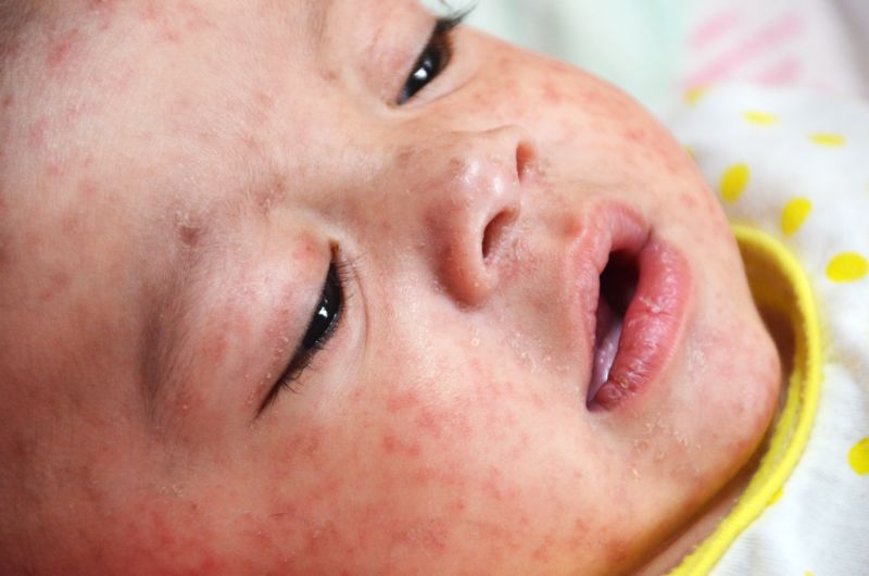 A baby with measles. 