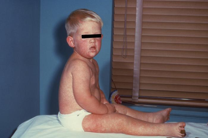 A young child, seated in a bed in a clinical setting, who had presented with an extensive rash, which had developed due to a measles infection. The image was captured on day-3 of the rash, which is usually when the rash manifests, beginning on the face, then adopting a more generalized distribution.